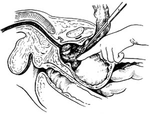 图1　耻骨上经膀胱前列腺切除术