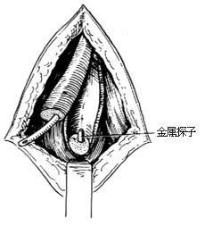 图1　球部尿道损伤修复术